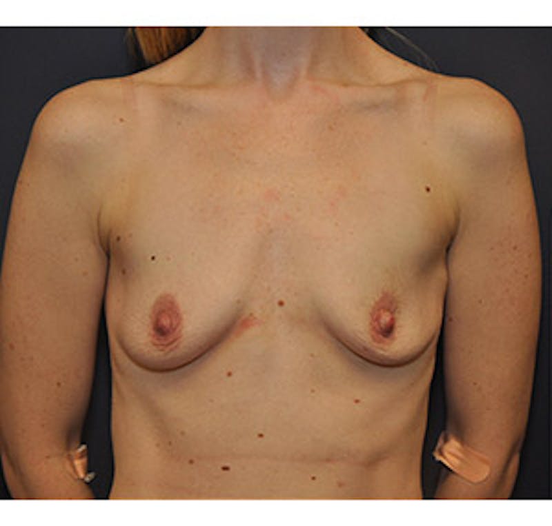 Breast Augmentation Before & After Gallery - Patient 122054476 - Image 1