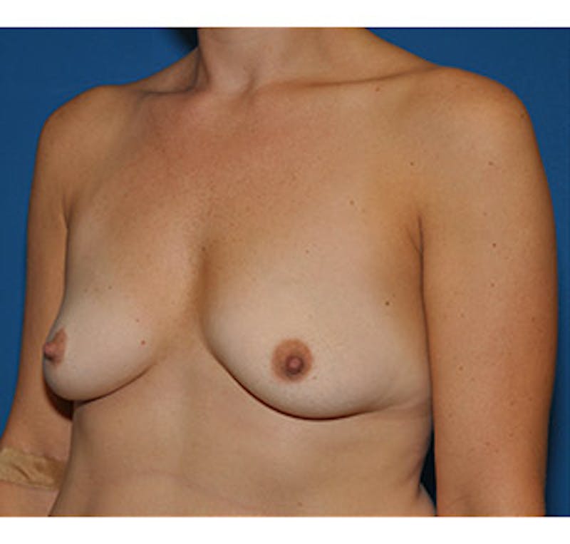 Breast Augmentation Before & After Gallery - Patient 122054475 - Image 3