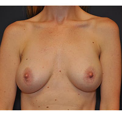 Breast Augmentation Before & After Gallery - Patient 122054476 - Image 2