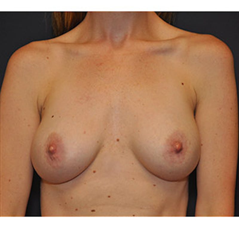 Breast Augmentation Before & After Gallery - Patient 122054476 - Image 2