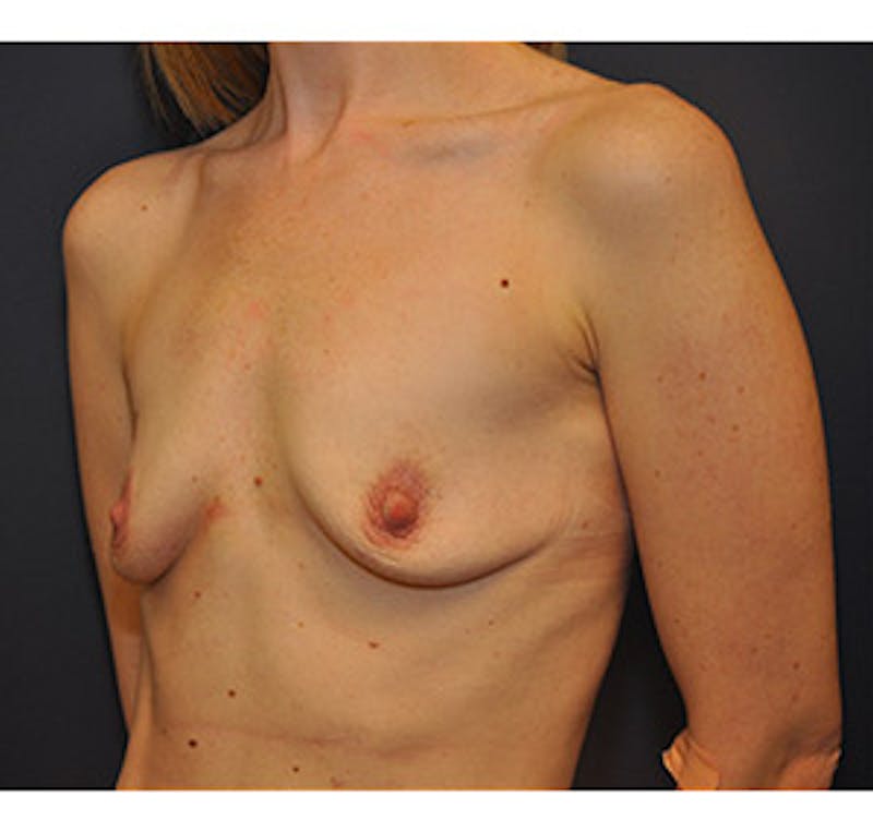 Breast Augmentation Before & After Gallery - Patient 122054476 - Image 3