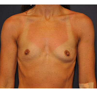 Breast Augmentation Before & After Gallery - Patient 122054477 - Image 1