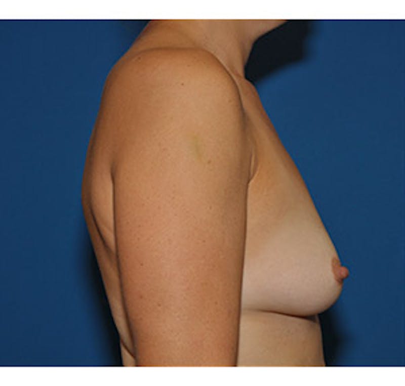 Breast Augmentation Before & After Gallery - Patient 122054475 - Image 5
