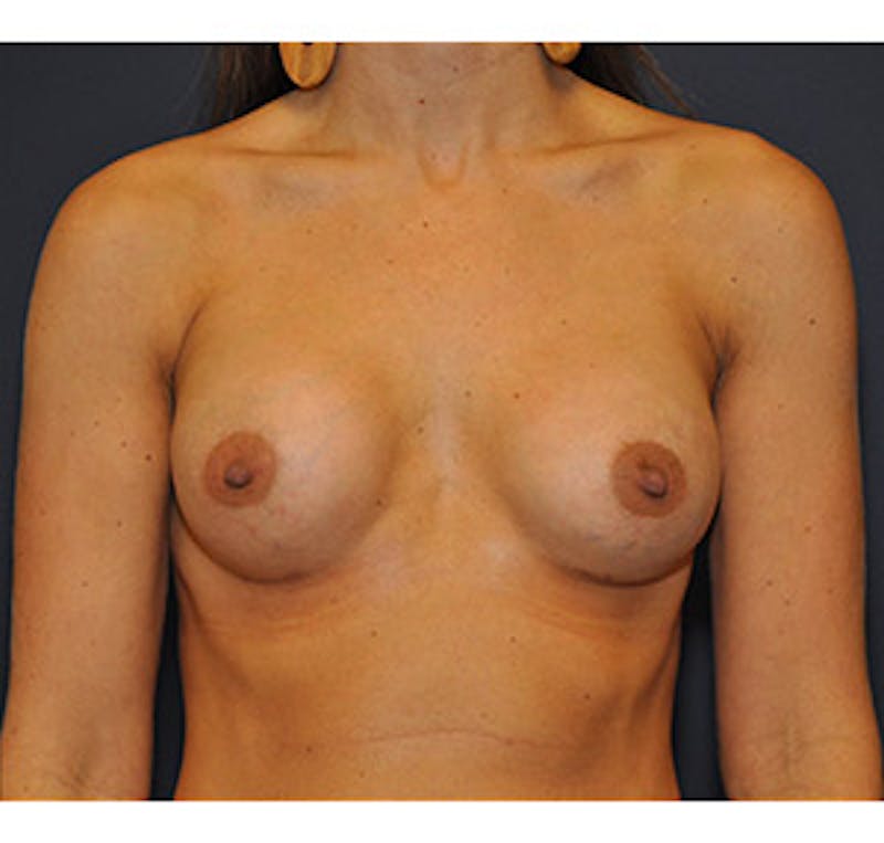 Breast Augmentation Before & After Gallery - Patient 122054477 - Image 2