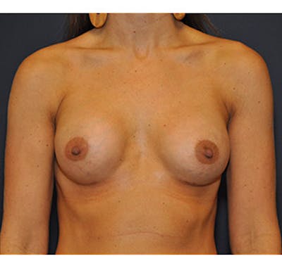 Breast Augmentation Before & After Gallery - Patient 122054477 - Image 2