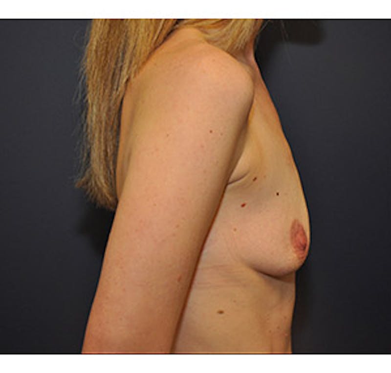 Breast Augmentation Before & After Gallery - Patient 122054476 - Image 5