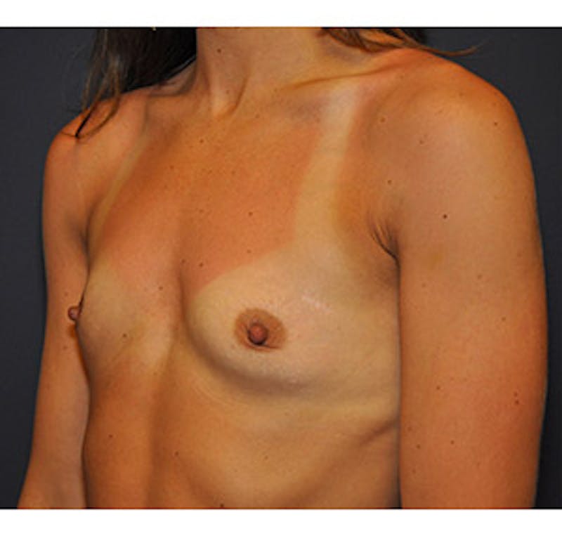 Breast Augmentation Before & After Gallery - Patient 122054477 - Image 3