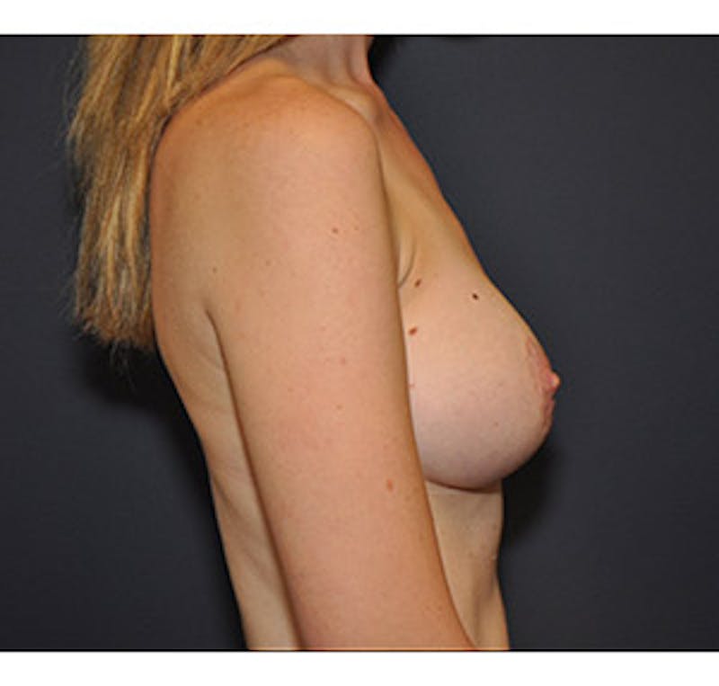 Breast Augmentation Before & After Gallery - Patient 122054476 - Image 6