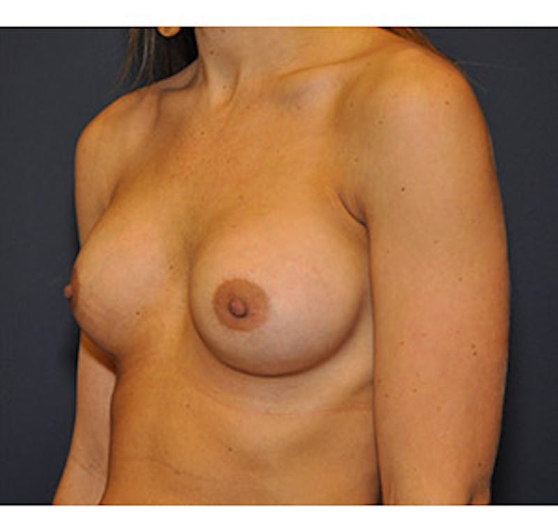 Breast Augmentation Before & After Gallery - Patient 122054477 - Image 4