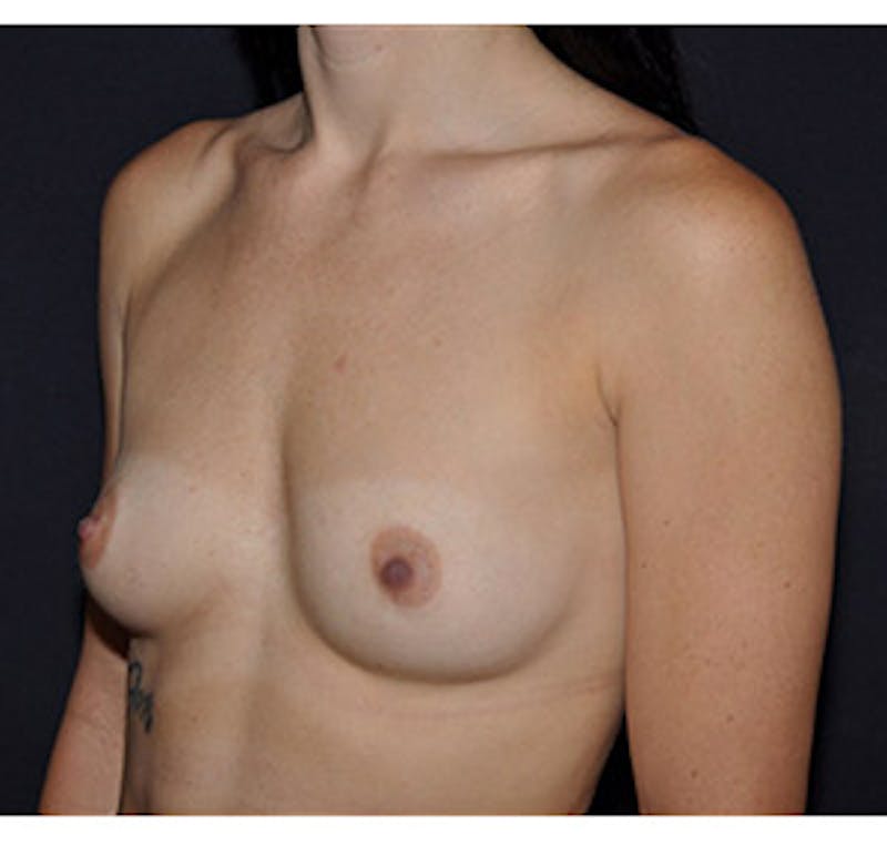 Breast Augmentation Before & After Gallery - Patient 122054478 - Image 1