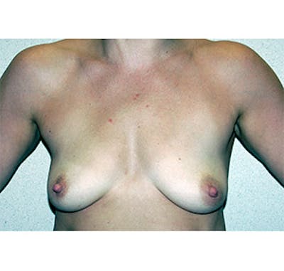 Breast Augmentation Before & After Gallery - Patient 122054519 - Image 1