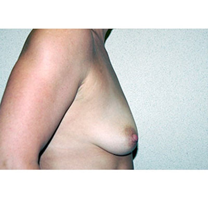 Breast Augmentation Before & After Gallery - Patient 122054519 - Image 5
