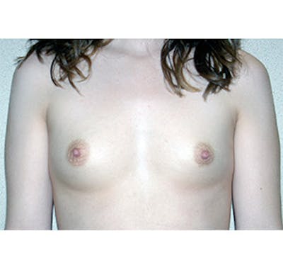 Breast Augmentation Before & After Gallery - Patient 122054520 - Image 1