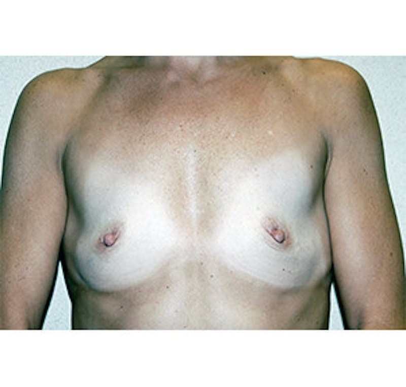 Breast Augmentation Before & After Gallery - Patient 122054522 - Image 1