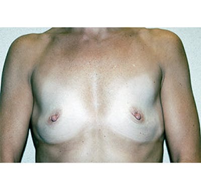 Breast Augmentation Before & After Gallery - Patient 122054522 - Image 1