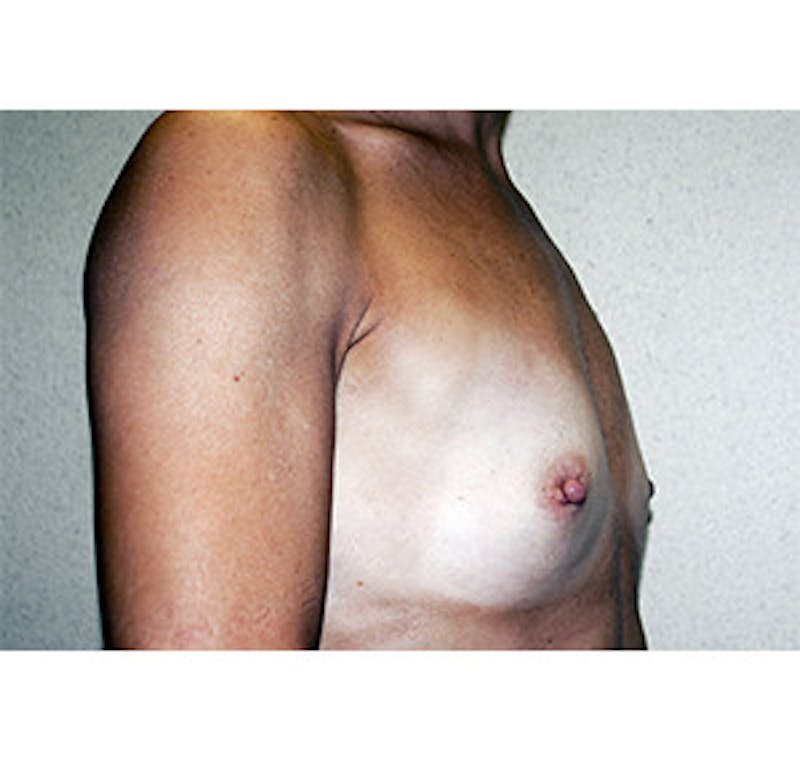 Breast Augmentation Before & After Gallery - Patient 122054522 - Image 3