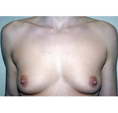 Breast Augmentation Before & After Gallery - Patient 122054524 - Image 1