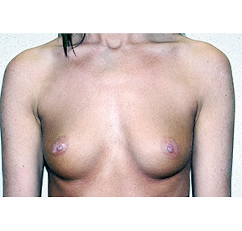 Breast Augmentation Before & After Gallery - Patient 122054529 - Image 1