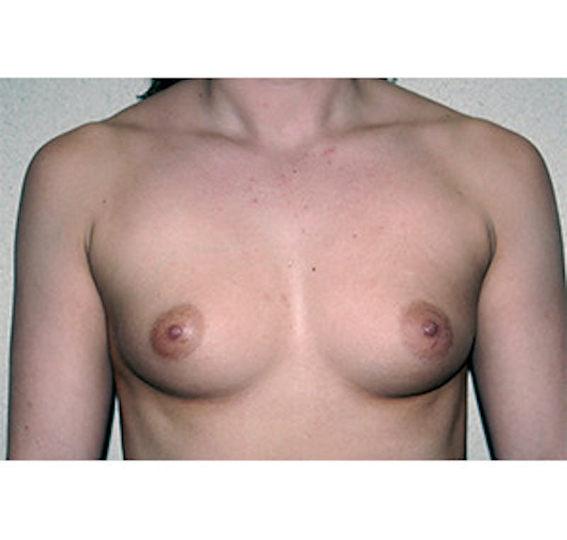 Breast Augmentation Before & After Gallery - Patient 122054530 - Image 1