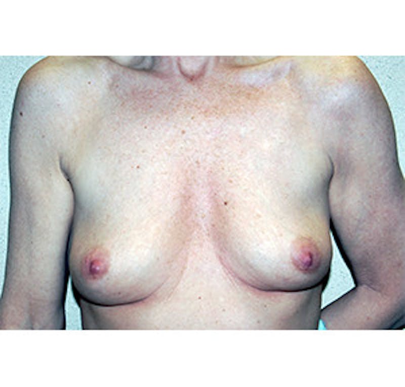 Breast Augmentation Before & After Gallery - Patient 122054531 - Image 1