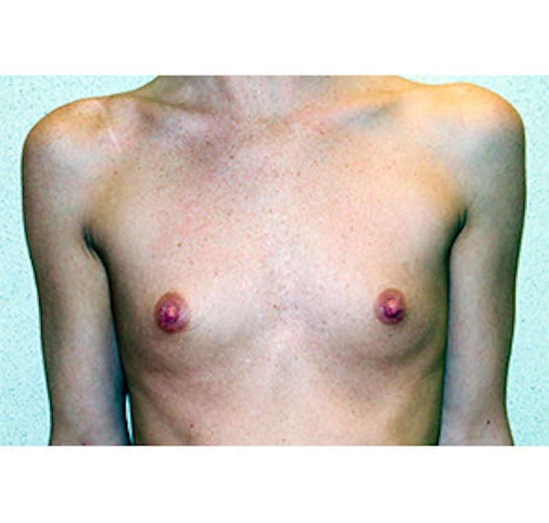 Breast Augmentation Before & After Gallery - Patient 122054540 - Image 1