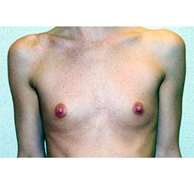 Breast Augmentation Before & After Gallery - Patient 122054540 - Image 1