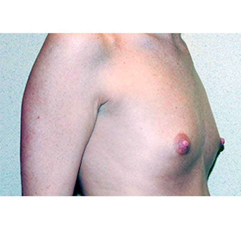 Breast Augmentation Before & After Gallery - Patient 122054540 - Image 3