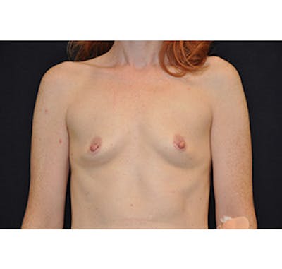 Breast Augmentation Before & After Gallery - Patient 122054562 - Image 1