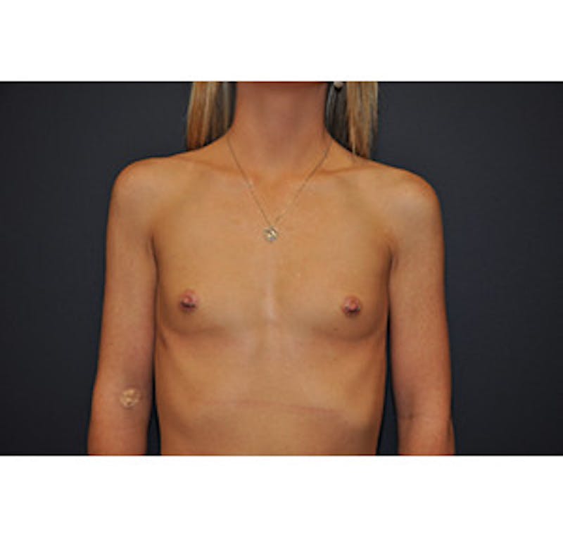 Breast Augmentation Before & After Gallery - Patient 122054564 - Image 1