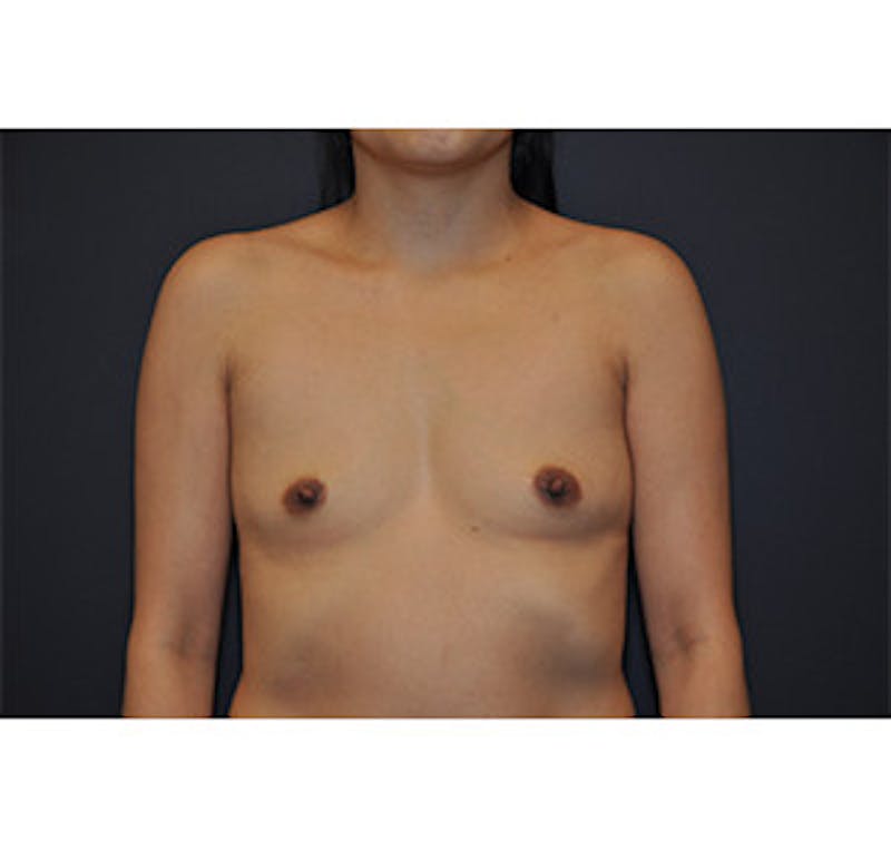 Breast Augmentation Before & After Gallery - Patient 122054565 - Image 1