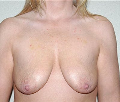 Breast Augmentation with Lift Before & After Gallery - Patient 122054685 - Image 1