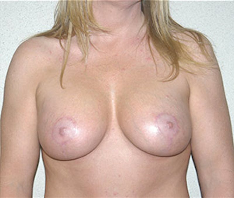 Breast Augmentation with Lift Before & After Gallery - Patient 122054685 - Image 2