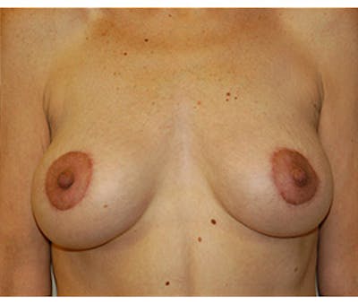 Breast Augmentation with Lift Before & After Gallery - Patient 122054690 - Image 2