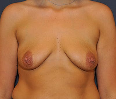 Breast Augmentation with Lift Before & After Gallery - Patient 122054693 - Image 1