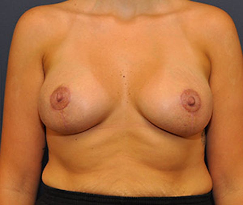Breast Augmentation with Lift Before & After Gallery - Patient 122054693 - Image 2