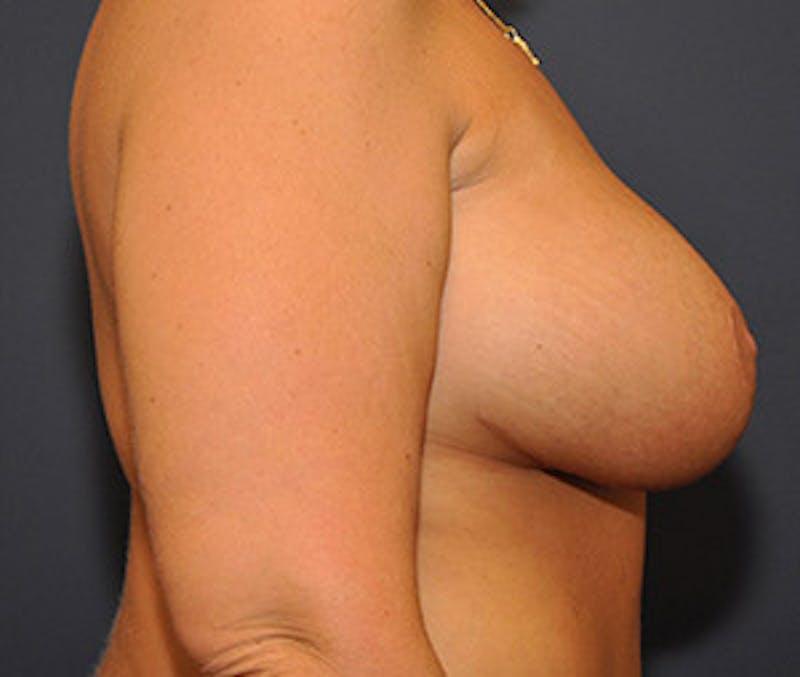 Breast Augmentation with Lift Before & After Gallery - Patient 122054692 - Image 6