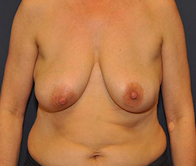 Breast Augmentation with Lift Before & After Gallery - Patient 122054694 - Image 1