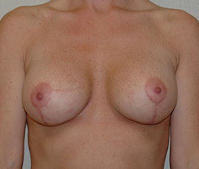 Breast Augmentation with Lift Before & After Gallery - Patient 122054696 - Image 2