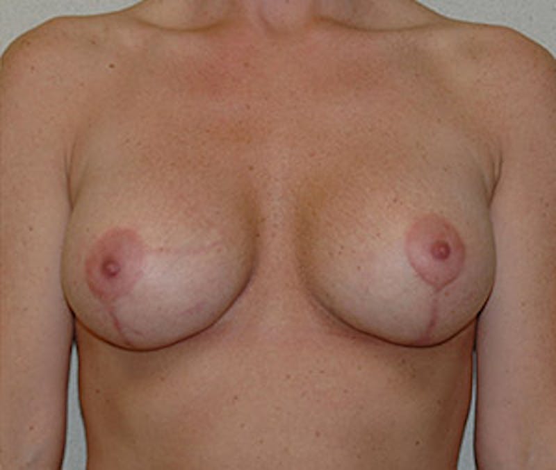 Breast Augmentation with Lift Before & After Gallery - Patient 122054696 - Image 2