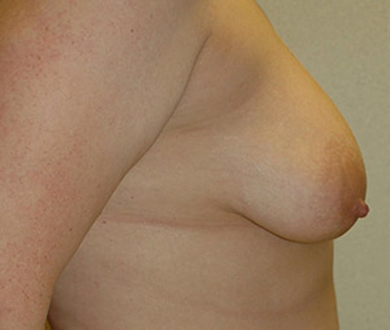 Breast Augmentation with Lift Before & After Gallery - Patient 122054695 - Image 3