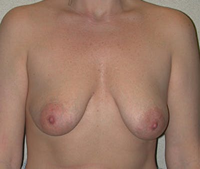 Breast Augmentation with Lift Before & After Gallery - Patient 122054697 - Image 1