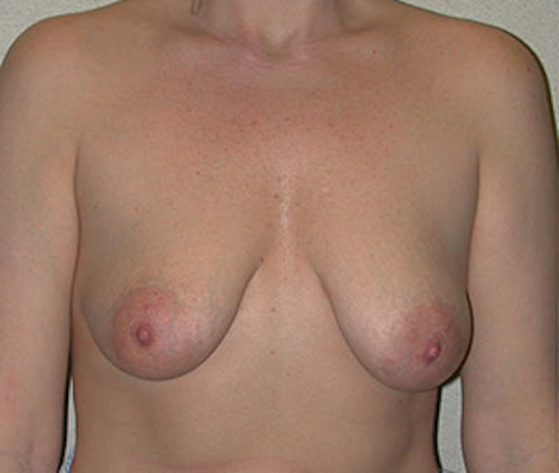 Breast Augmentation with Lift Before & After Gallery - Patient 122054697 - Image 1