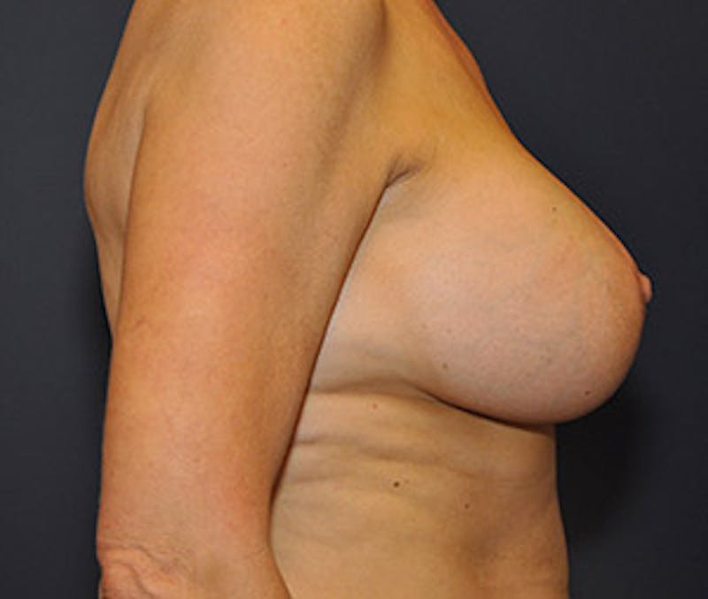 Breast Augmentation with Lift Before & After Gallery - Patient 122054694 - Image 6