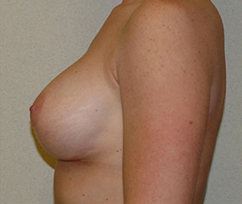 Breast Augmentation with Lift Before & After Gallery - Patient 122054696 - Image 6