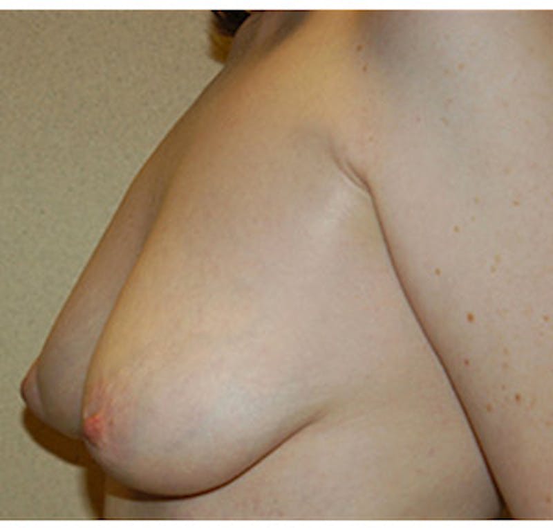 Breast Lift Before & After Gallery - Patient 122054728 - Image 5