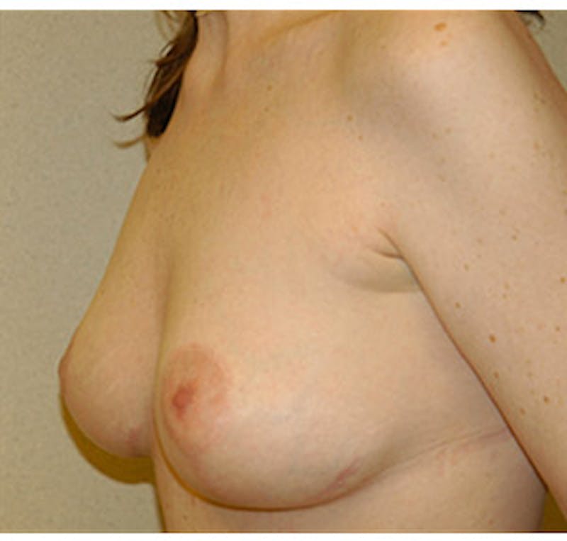 Breast Lift Before & After Gallery - Patient 122054728 - Image 6