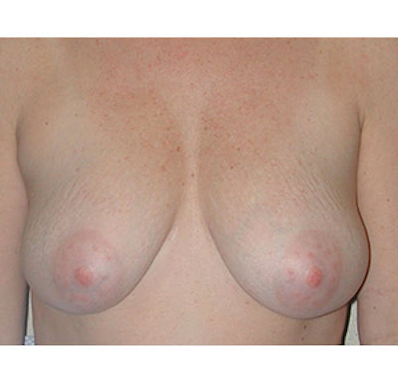 Breast Lift Before & After Gallery - Patient 122054729 - Image 1