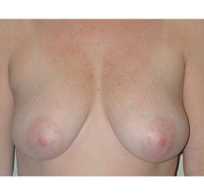 Breast Lift Before & After Gallery - Patient 122054729 - Image 1