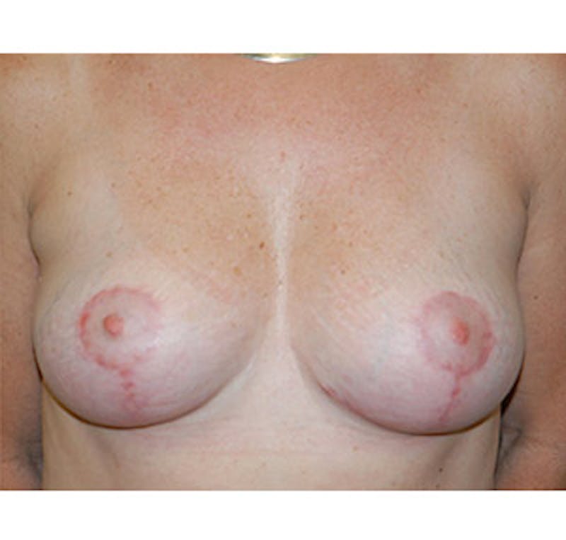 Breast Lift Before & After Gallery - Patient 122054729 - Image 2