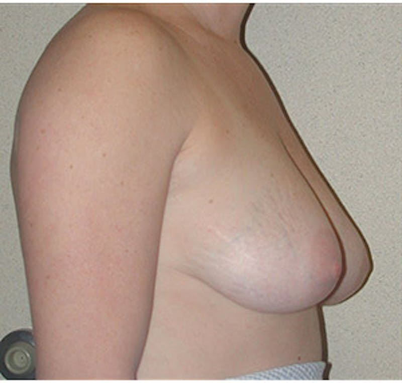 Breast Lift Before & After Gallery - Patient 122054729 - Image 3